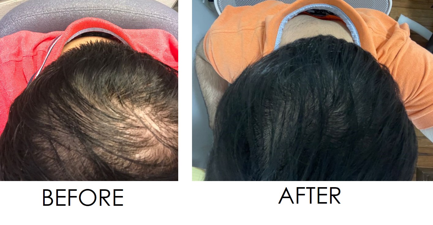 Hair growth Treatment